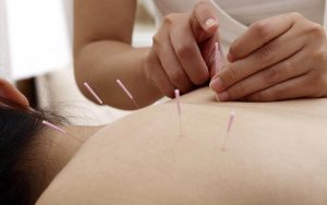 experienced acupuncture therapist