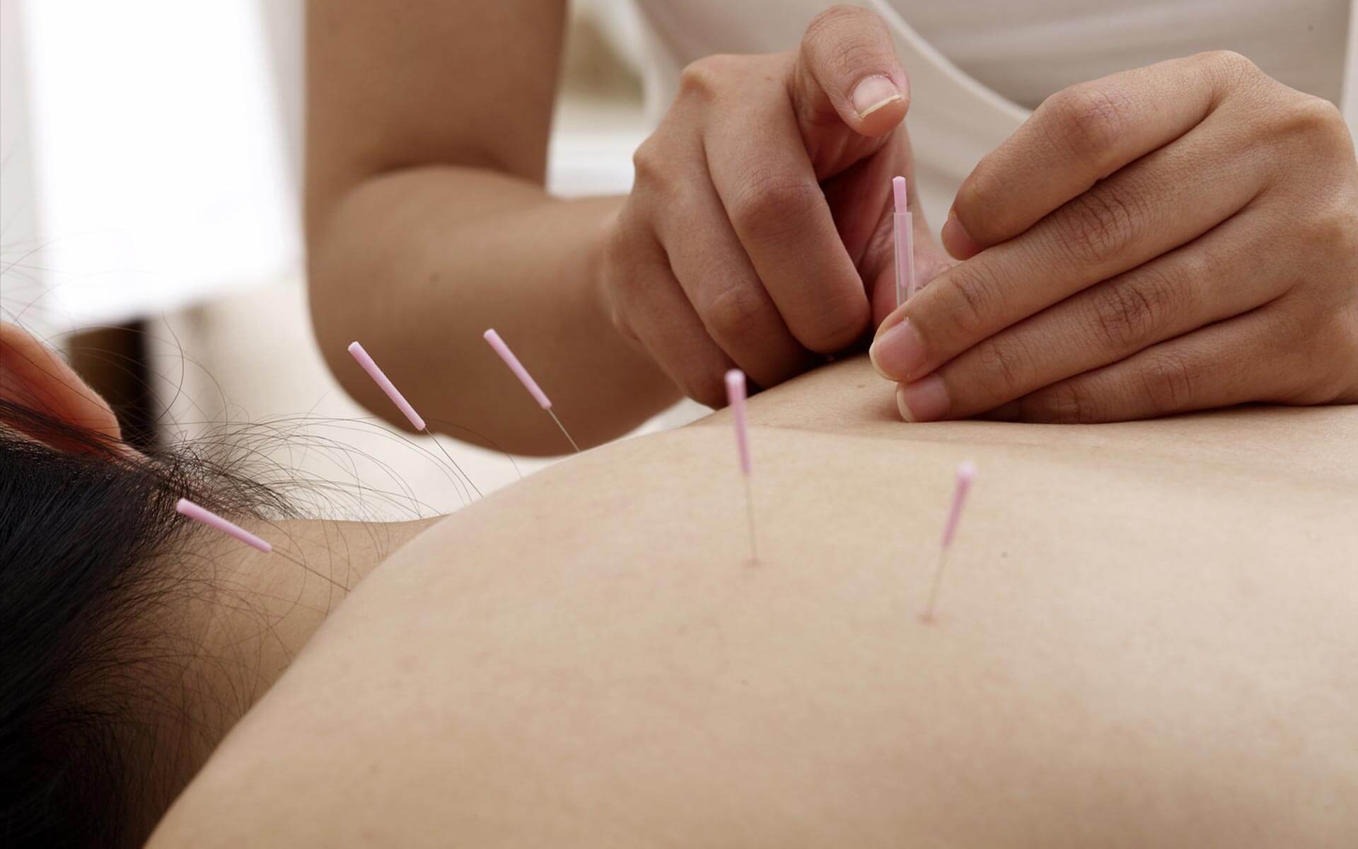 Acupuncture for Coders Finding Right Therapist